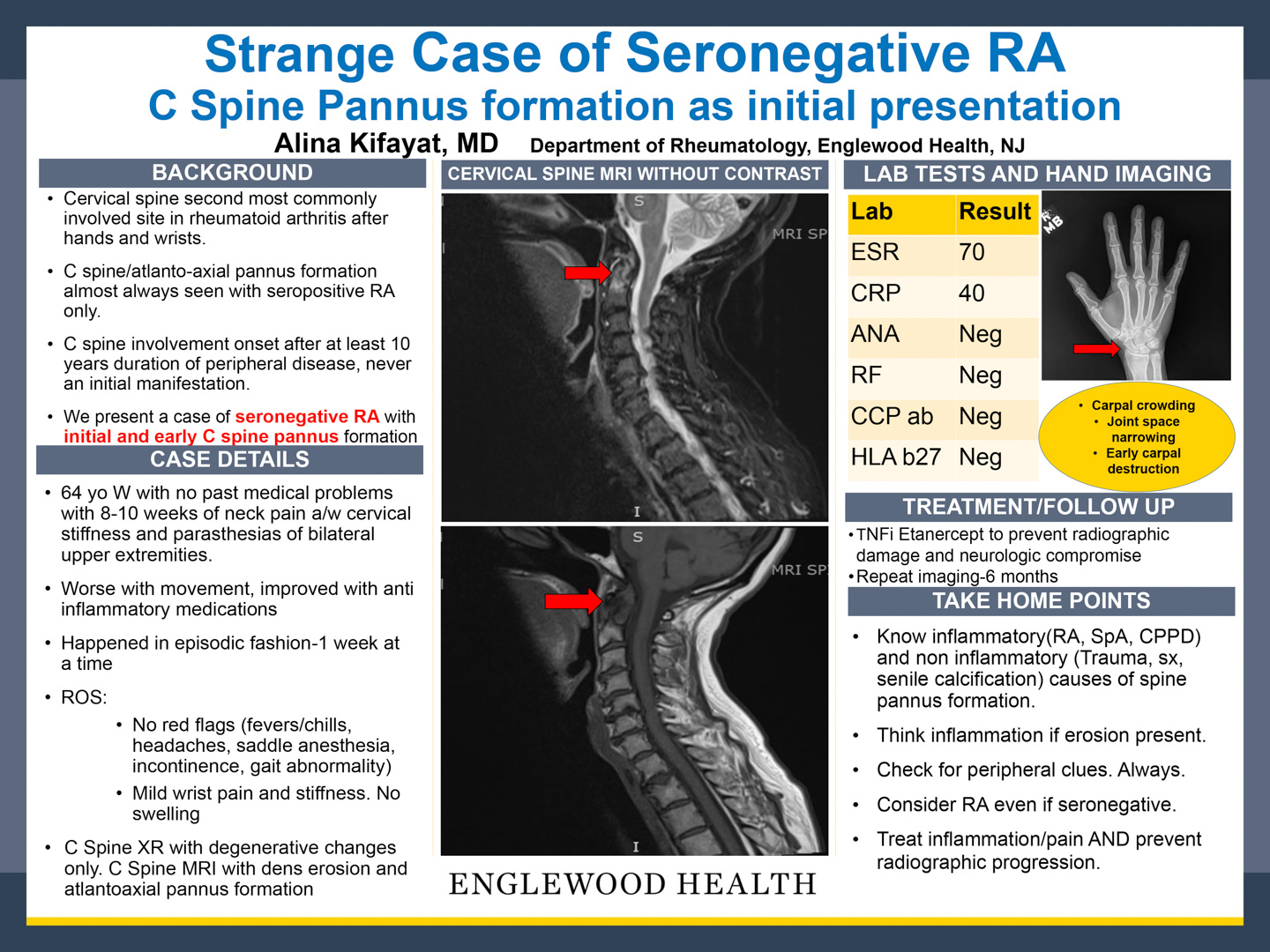 Image of poster - Strange Case of Seronegative RA: C Spine Pannus formation as initial presentation