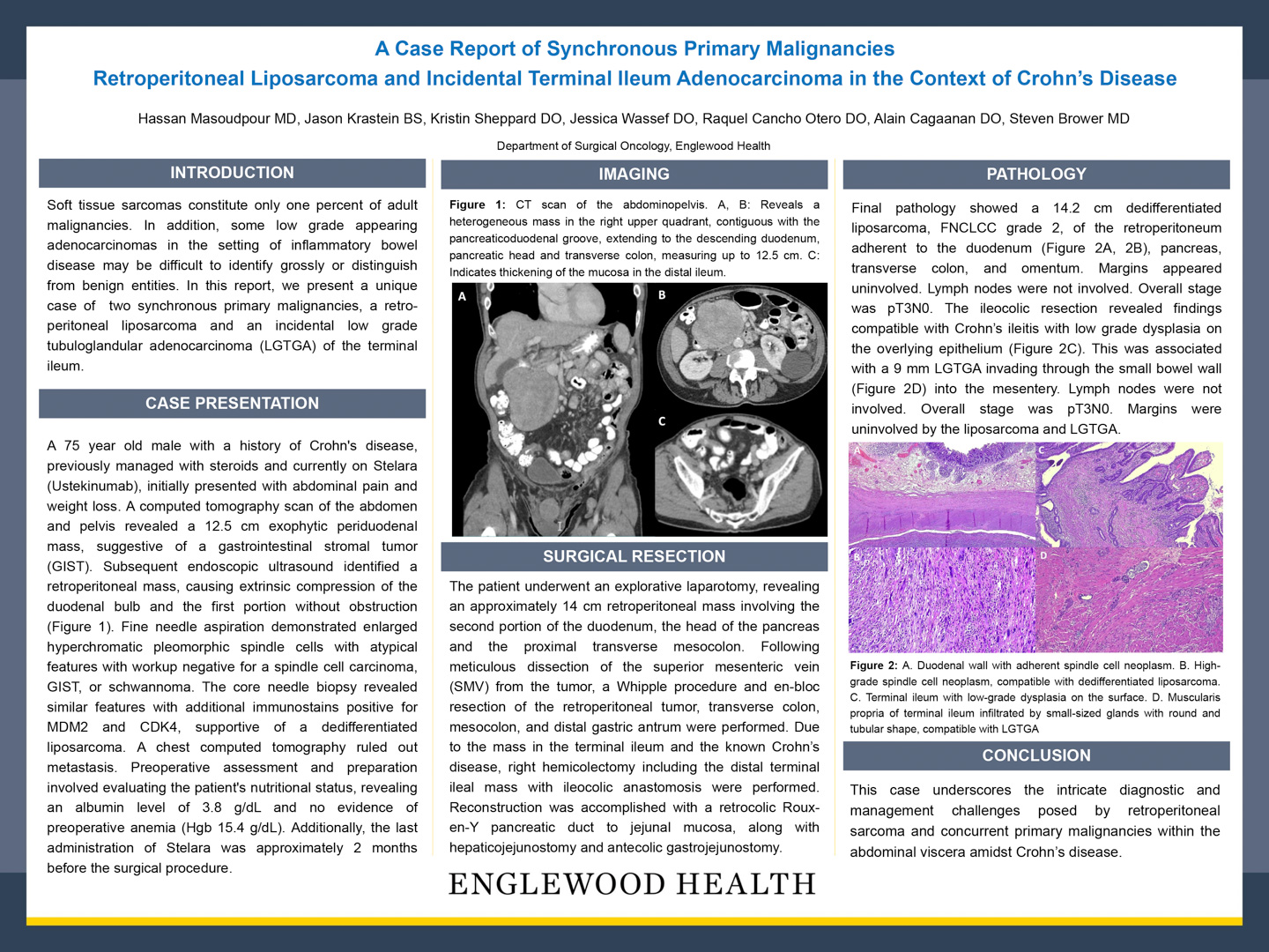 Image of poster - A Case Report of Synchronous Primary Malignancies: Retroperitoneal Liposarcoma and Incidental Terminal Ileum Adenocarcinoma in the Context of Crohn's Disease