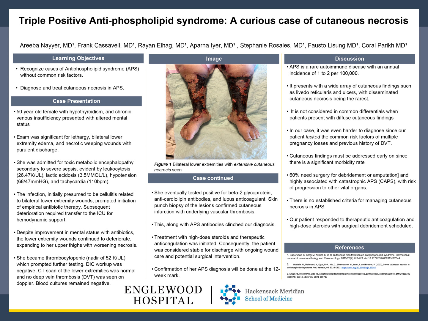 Image of poster - Triple Positive Anti-phospholipid Syndrome: A Curious Case of Cutaneous Necrosis