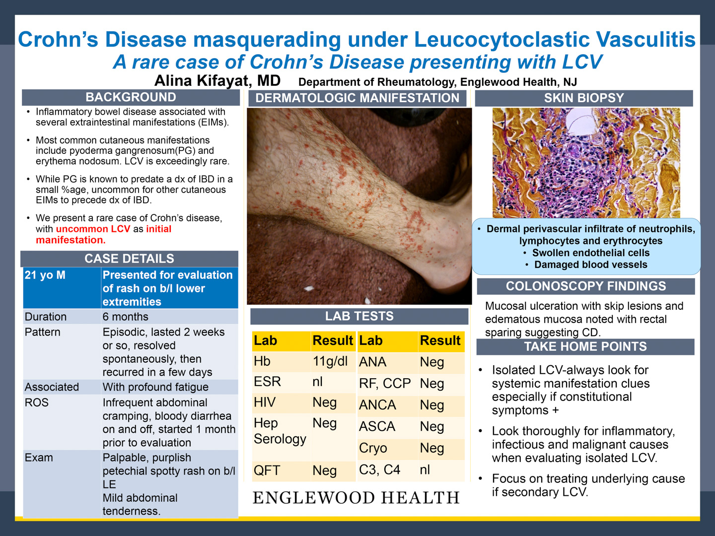 Image of poster - Crohn's Disease Masquerading under Leucocytoclastic Vasculitis