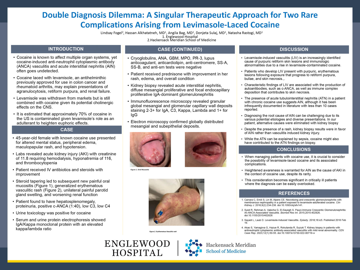 Image of poster - Double Diagnosis Dilemma: A Singular Therapeutic Approach for Two Rare Complications Arising from Levimasole-Laced Cocaine