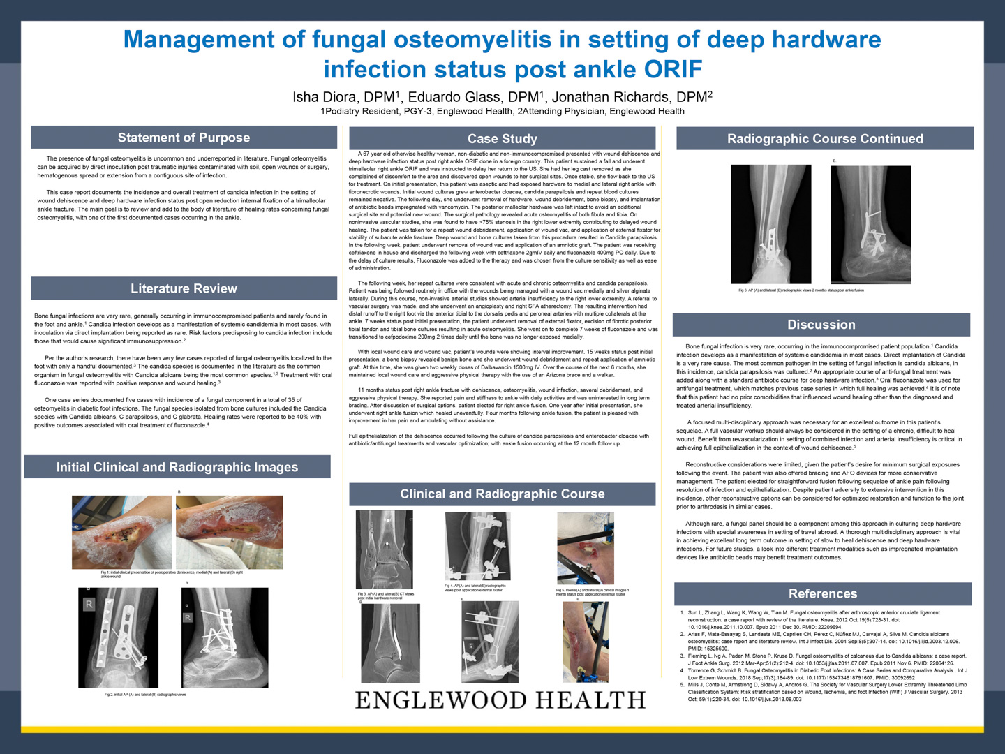 Image of poster - Management of Fungal Osteomyelitis in Setting of Deep Hardware Infection Status Post Ankle ORIF